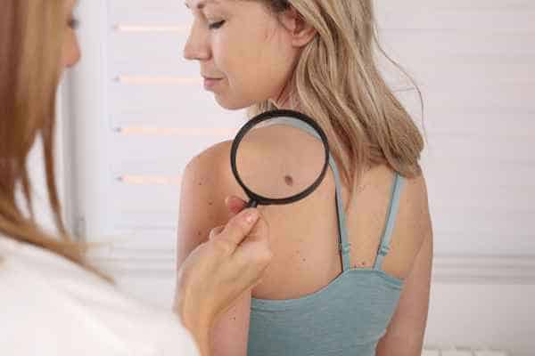 What Are Traditional Skin Lesion Removal Methods Epping?