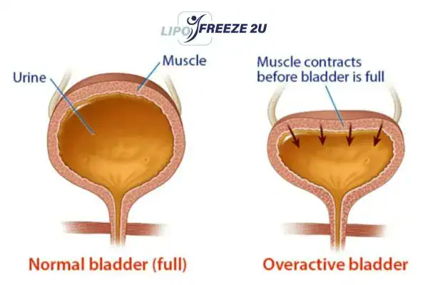 diagram of overactive bladder treatment Epping