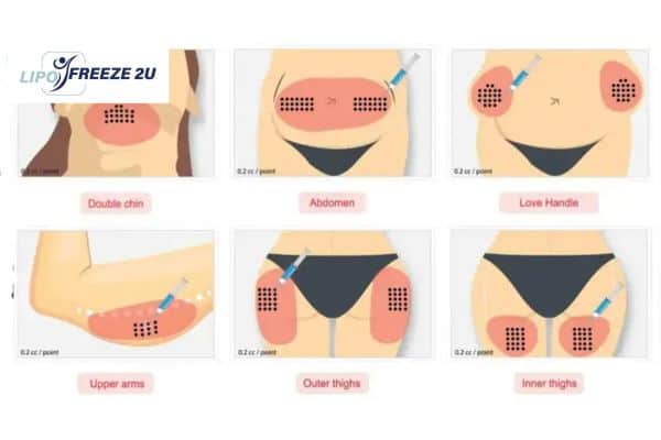 Benefits of Choosing Aqualyx for Fat Reduction Epping