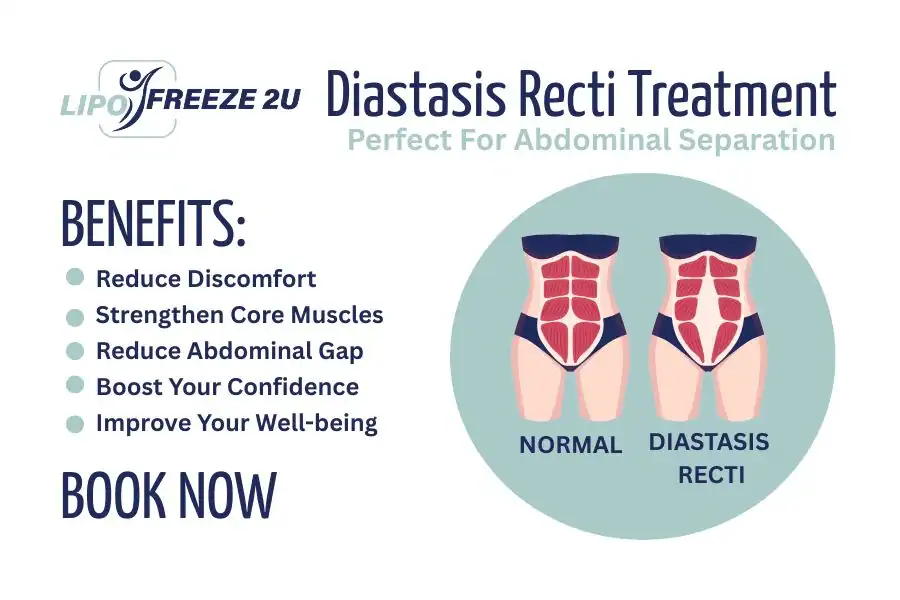 Benefits of body toning treatment Epping for Diastasis recti