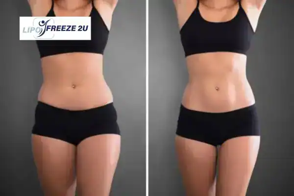 How Can LIPO FREEZE 2U Support Your Post-Pregnancy Body Recovery Epping?