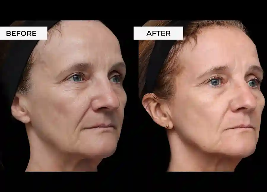 How Many RF Microneedling Sessions Will You Need to See a Difference Epping?