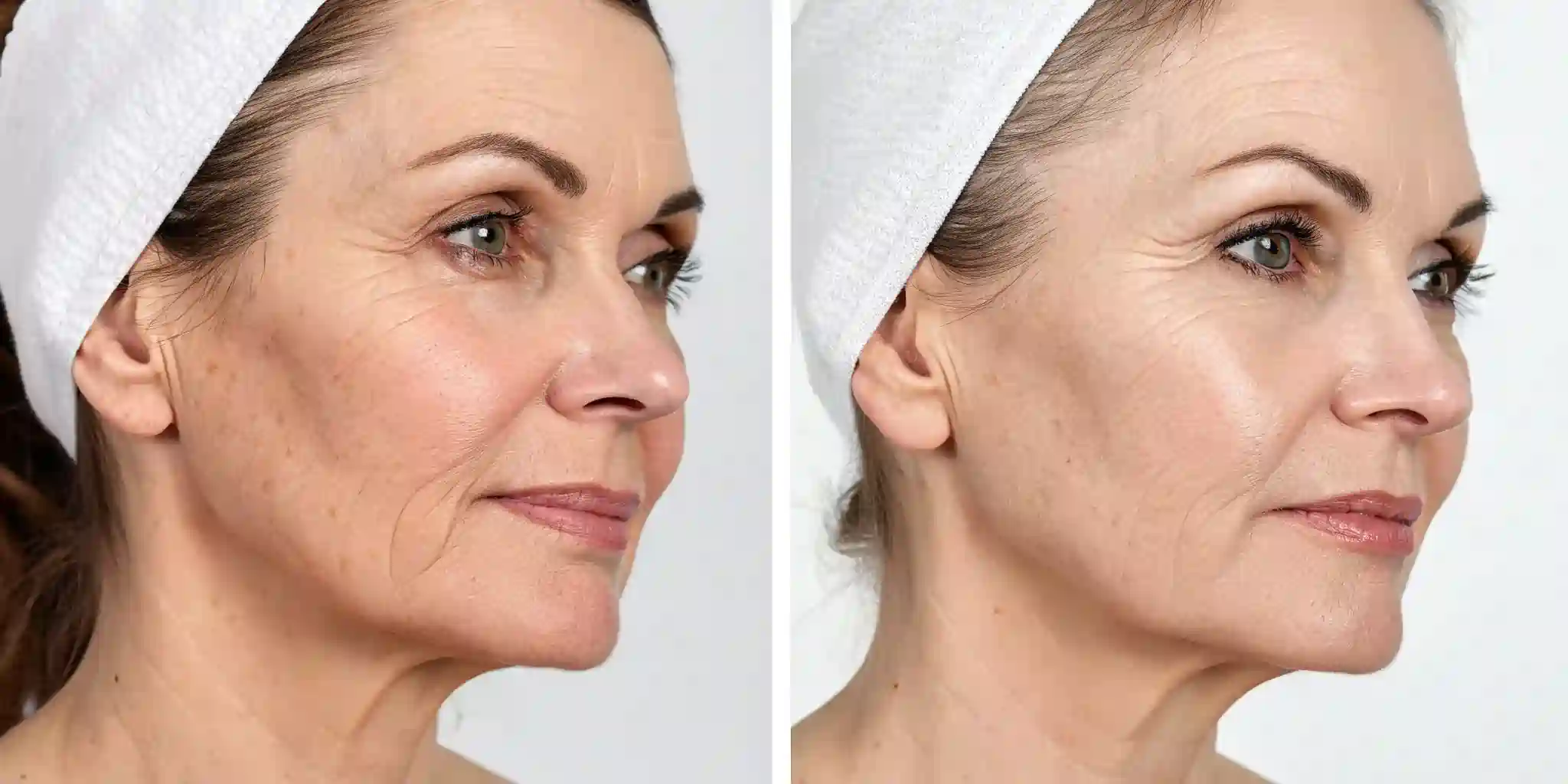 Common Questions About RF Microneedling and Loose Skin Epping