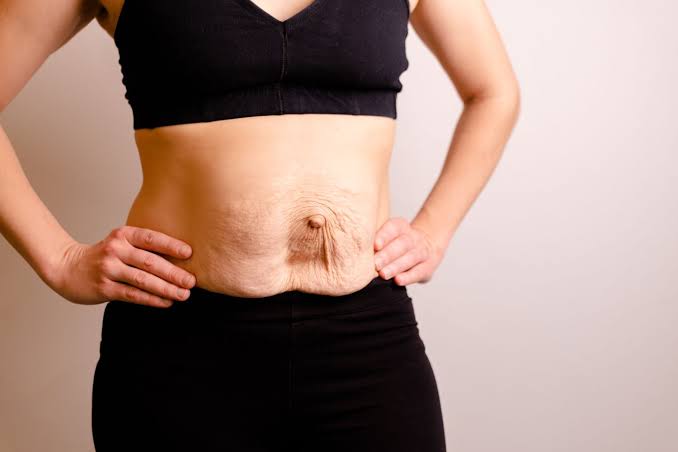 Is Surgery Really the Only Way to Repair Diastasis Recti Epping?