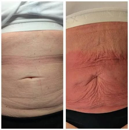 How Does RF Microneedling Improve Crepey, Thin and Uneven Skin Texture Epping?