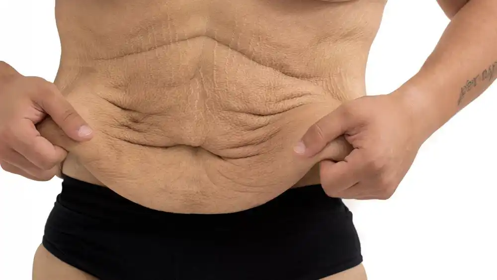 RF Microneedling for Loose Skin: How Can It Help Tighten and Reshape the Skin Epping?